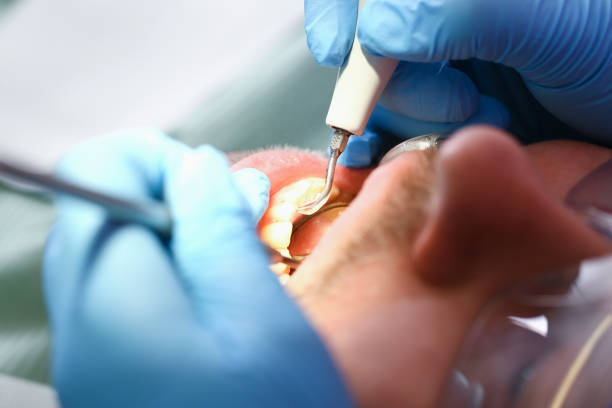 Best Emergency Dental Extractions in Mbrian Park, CA